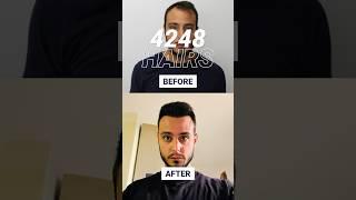 Before and After - 12 Months Hairline Hair Transplant Result #hairtransplantbudapest