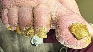 Cutting Thick Nails and Severe Callus Removal on a 90-Year-Old  Expert Foot Care Transformation