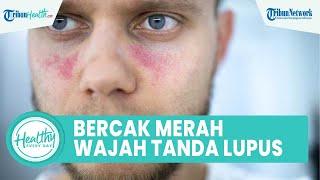 Waspadai Bercak Merah di Wajah Bisa Jadi Gejala Penyakit Lupus Inilah Gejala yang Perlu Diketahui