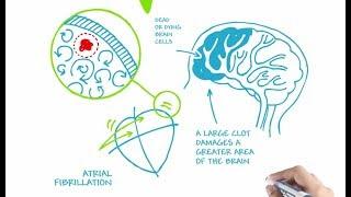 Understanding Atrial Fibrillation - Why Preventing Blood Clots is Crucial