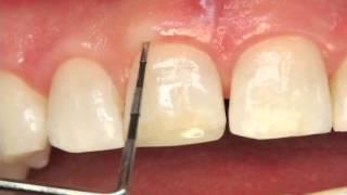 Periodontal Probing