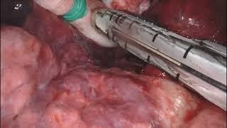 Asvide Robotic right-S2 segmentectomy in a 59-years-old smoking woman affected by a 14 mm...