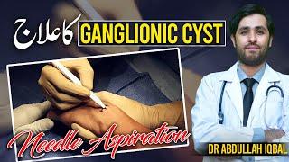 Ganglion Cyst Aspiration and Steroid Injection  Ganglion Cyst Removal  Ganglionic Cyst Ka Ilaj