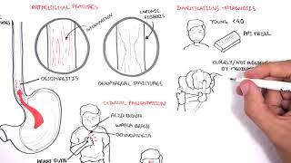 GORD GERD Gastro Oesophageal Reflux Disease  - Overview pathophysiology treatment