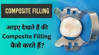 Composite Filling l Composite फीलिंग कैसे करते हैं?