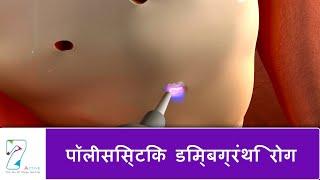 पॉलीसिस्टिक डिम्बग्रंथि रोग  Polycystic Ovarian Disease  Hindi