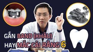 Vì Sao Phải Gắn Band Khâu Chỉnh Nha Mà Không Phải Mắc Cài Răng Số 6 Và Ngược Lại?