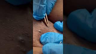 BLACKHEAD POPS OUT AND THE INGROWN HAIR IS EXTRACTED. THIS IS A SATISFYING EXTRACTION VIDEO. ENJOY