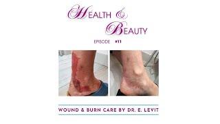 Wound and burn care by Dr. E. Levit.