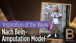 Nach Krebs 24-Jährige wird nach Bein-Amputation Model  Place to B Stars & Stories