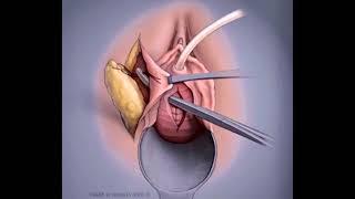 Urethrolysis and Martius flap for failed sling and fixed urethra