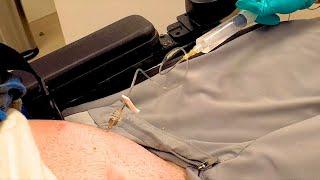 Quadriplegic Refills His Baclofen Pump