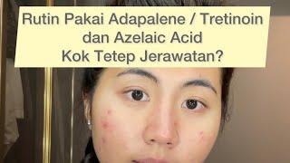 Rutin Pakai Adapalene  Tretinoin & Azelaic Acid Kok Tetap Jerawatan??