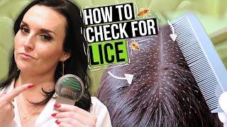 How to Check for Lice - 5 Lice Treatment Tips from a Professional