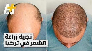 تجربة زراعة الشعر.. كيف تتم العملية؟ ولماذا صارت تركيا إحدى أشهر وجهاتها؟