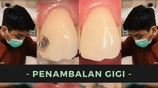 Tambalan Gigi Komposit  Dentist  Dokter Gigi Tri Putra