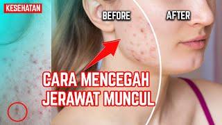 JERAWATAN INI 9 CARA AMPUH MENCEGAH JERAWAT MUNCUL KEMBALI