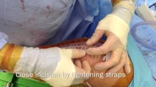 Zip Surgical Skin Closure manufactured and submitted by ZipLine Medical Inc  USA2