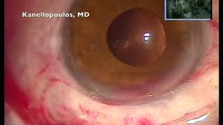 Dislocated IOLcapsule Exchange with a retro-pupillary  iris-clawArtisan Kanellopoulos MD