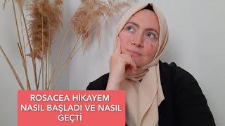 ROSACEA HİKAYEM NASIL BAŞLADI VE NASIL GEÇTİ ️ GÜL HASTALIĞI