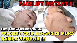 PROSES TARIK BENANG DI MUKA TANPA SENSOR  - FACELIFT INSTANT