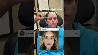 Scarless ptosis surgery