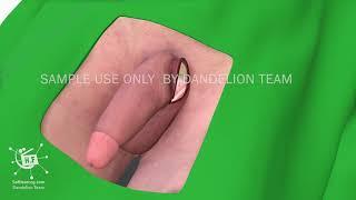 penis implant 3d medical animation  sample use only  by Dandelion Team