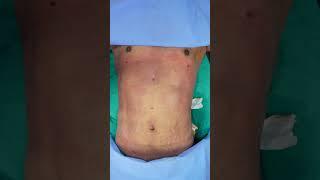 Liposuction  Weight Loss After 360° Abdomen liposuction result #shorts