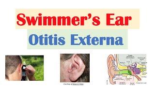 Swimmer’s Ear Otitis Externa  Risk Factors Causes Signs & Symptoms Diagnosis Treatment