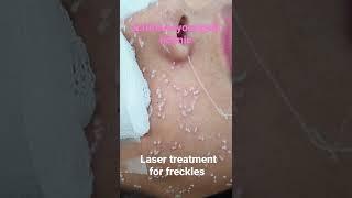 Freckles are small brown spots on skin .Increase in summer.Can be treated with a Q switch laser.