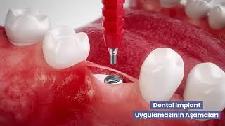 Dental İmplantın Aşamaları Nelerdir?