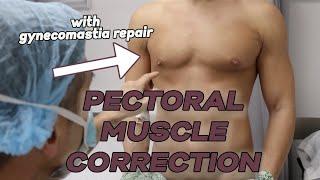 Pectoral Muscle Injury Correction with Liposuction and Fat Grafting Gynecomastia Correction