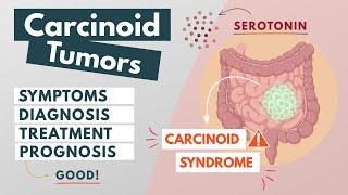 Carcinoid Tumor  Visual Explanation  Symptoms diagnosis treatment prognosis