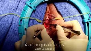 How To Become A VIRGIN Again - Hymenoplasty