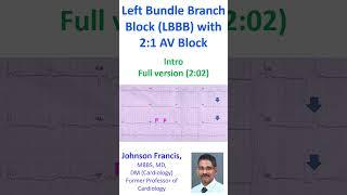 Left Bundle Branch Block LBBB with 21 AV Block