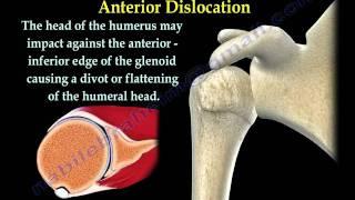 Shoulder Dislocations Everything You Need To Know - Dr. Nabil Ebraheim