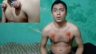 bekam dada & punggung lagii - cupping therapy