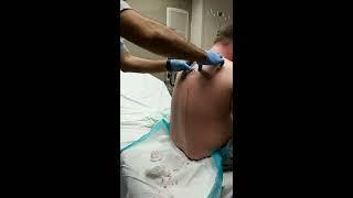 Large cyst Bursts out mans back Viewer beware