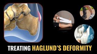 How to TREAT Haglunds Deformity? Home Treatments and Doctors Treatment Options 2021