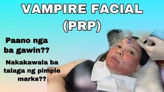 VAMPIRE FACIAL  PRP TREATMENT