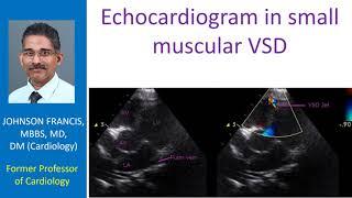 Echocardiogram in small muscular VSD