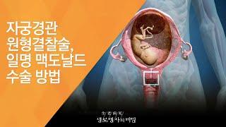 자궁경관 원형결찰술 일명 맥도날드 수술 방법 - 20140212_493회 방송_출산의 두려움 조산