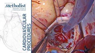 TAVR Explantation Due to Late Thrombosis Leading to Cardiogenic Shock M Reardon S Goel Q Al Abri