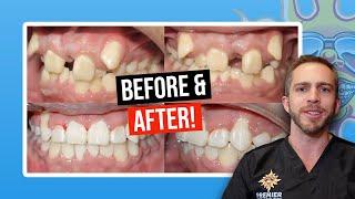 Braces BEFORE & AFTER Severe Crowding