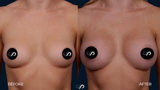 L.A. Natural Breast Augmentation  Los Angeles  Dr. David Stoker