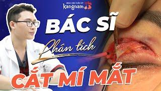 Bác sĩ phân tích kỹ thuật Cắt mí mắt Plasma