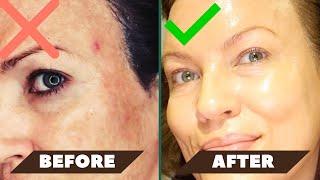 VISIBLE RESULTS IN ONLY 7 DAYS Most POWERFUL Ive EVER USED to FADE DARK SPOTS  no hydroquinone