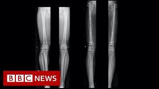 Leg-lengthening The people having surgery to be a bit taller - BBC News