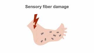 Diabetic Neuropathy Advanced Management Techniques