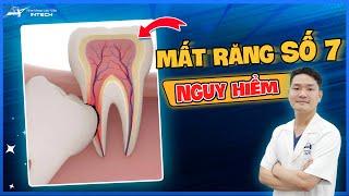 Mất Răng Số 7 Liệu Có Nguy Hiểm? Mất Răng Số 7 Phải Làm Sao?